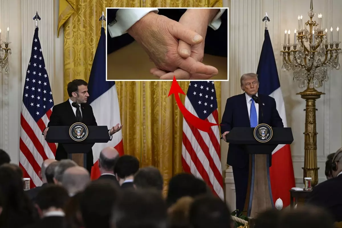 Beyaz Saray Trump'ın elindeki morluğa açıklık getirdi